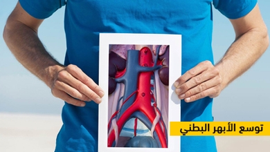 توسع الأبهر البطني