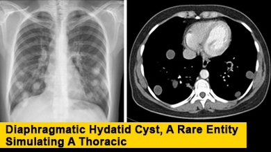 Diaphragmatic Hydatid Cyst, A Rare Entity Simulating A Thoracic