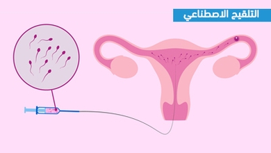 التلقيح الاصطناعي