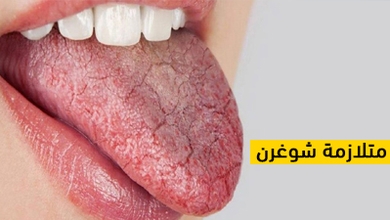 متلازمة شوغرن