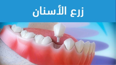 زرع الأسنان