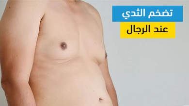 تضخم الثدي عند الرجال