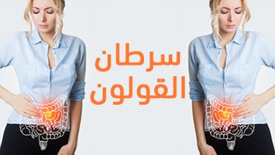 سرطان القولون