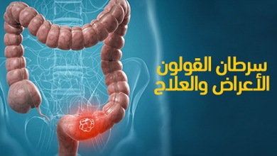 سرطان القولون : الأعراض والعلاج