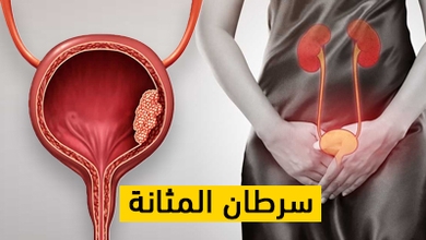 سرطان المثانة