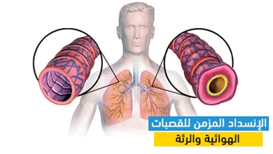 الإنسداد المزمن للقصبات الهوائية والرئة
