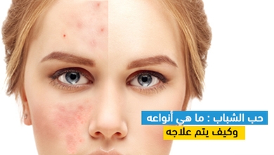 حب الشباب: ما هي أنواعه وكيف يتم علاجه