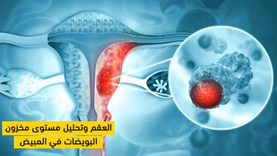 العقم وتحليل مستوى مخزون البويضات في المبيض