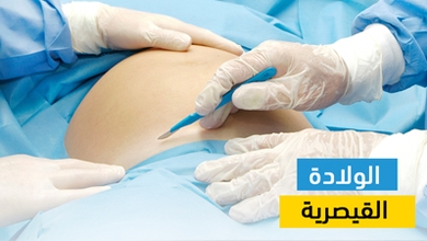 الولادة القيصرية