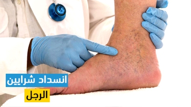 انسداد شرايين الرجل