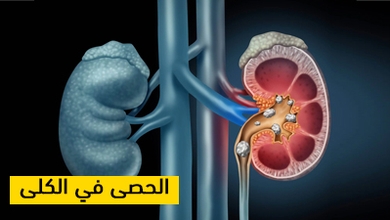 الحصى في الكلى