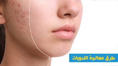 طرق معالجة الندوبات