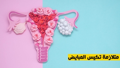 متلازمة تكيس المبايض