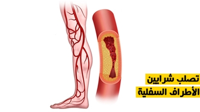 تصلب شرايين الأطراف السفلية