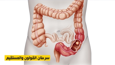 سرطان القولون والمستقيم