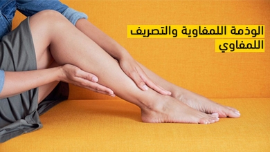 الوذمة اللمفاوية والتصريف اللمفوي