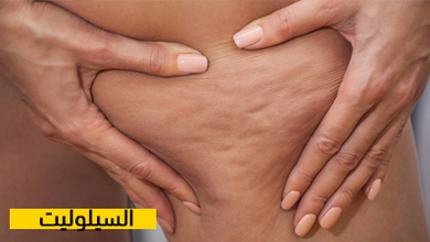 السيلوليت