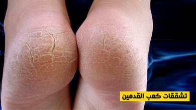 تشققات كعب القدمين