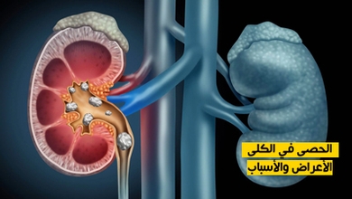 الحصى في الكلى : الأعراض والأسباب