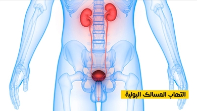 التهاب المسالك البولية