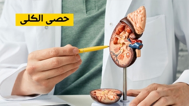حصى الكلى