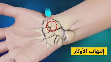 التهاب الأوتار