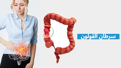 سرطان القولون