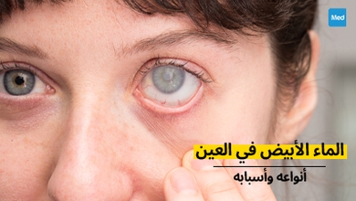 الماء الأبيض في العين : أنواعه وأسبابه