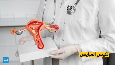 تكيس المبايض