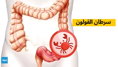 سرطان القولون