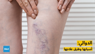 الدوالي: أسبابها وطرق علاجها