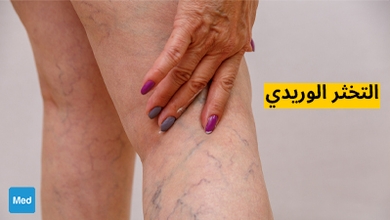 التخثر الوريدي