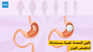 بالون المعدة: تقنية مستحدثة لتخفيض الوزن