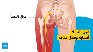 عرق النسا: أسبابه وطرق علاجه