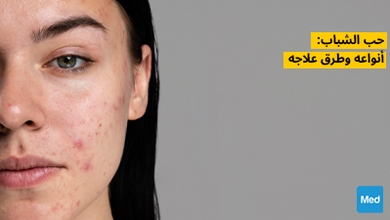 حب الشباب: أنواعه وطرق علاجه