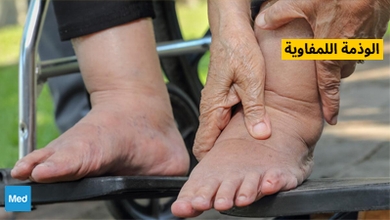 الوذمة اللمفاوية