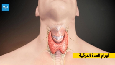 أورام الغدة الدرقية