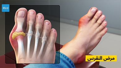 مرض النقرس