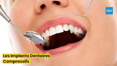 Sourire Confiant : Tout ce que Vous Devez Savoir sur les Implants Dentaires Compressifs