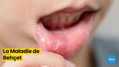 Comprendre la Maladie de Behçet : Symptômes, Diagnostic et Gestion