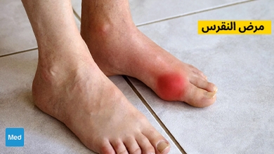 مرض النقرس - التشخيص والأسباب والعلاج