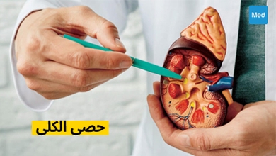 حصى الكلى: الأسباب والأعراض والعلاج
