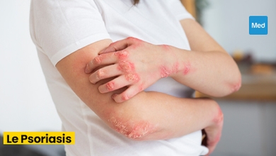Psoriasis : comprendre la maladie et vivre au mieux
