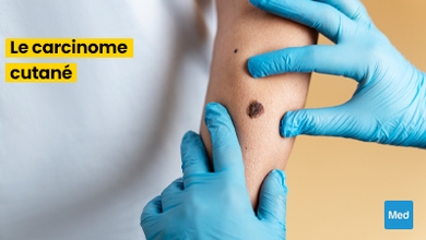  Tout ce que vous devez savoir sur le carcinome cutané