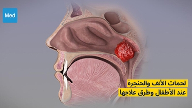 لحمات الأنف والحنجرة وطرق علاجها