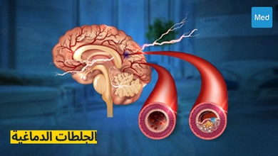 الجلطات الدماغية: الأسباب، الأعراض، التشخيص، والعلاج