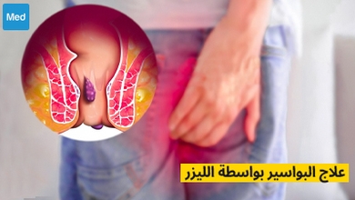 علاج البواسير بواسطة الليزر