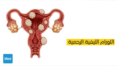 الأورام الليفية الرحمية: تعريف، أعراض، تشخيص وعلاج