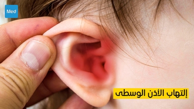 التهاب الأذن الوسطى
