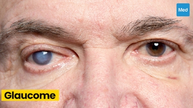 Le glaucome : une maladie grave mais traitable